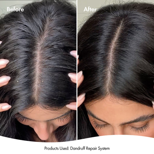Before and after comparison of hair with dandruff using a dandruff repair system.