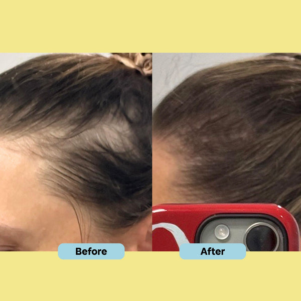 Before and after comparison of hair growth on a person's head.